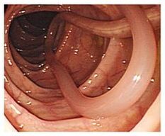 parasites in the human body