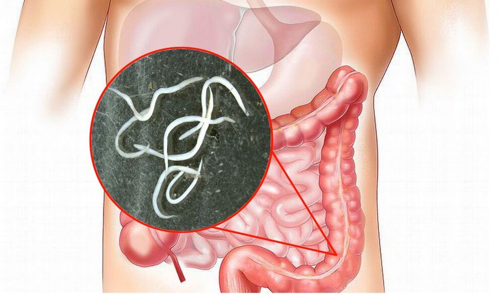 worms in the intestine