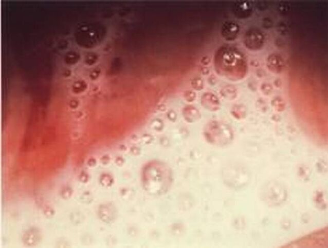 discharge of bubbles with protozoan parasites