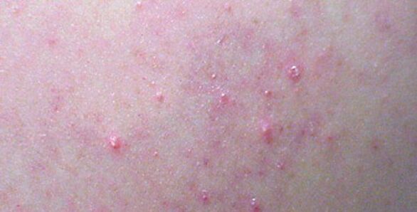 Rashes on the body can be a sign of helminthiasis