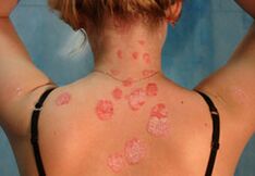 infection